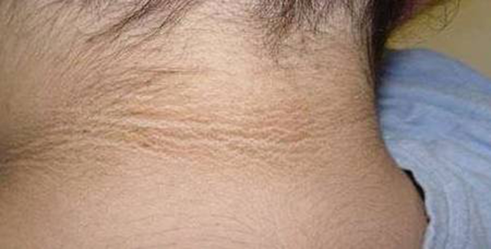 頸部皮膚黑變病