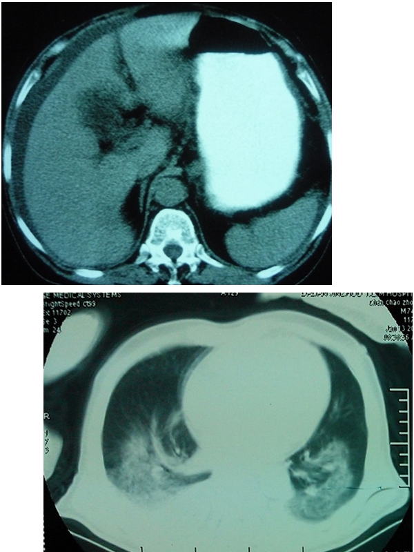 胸水腹水鑑別ct