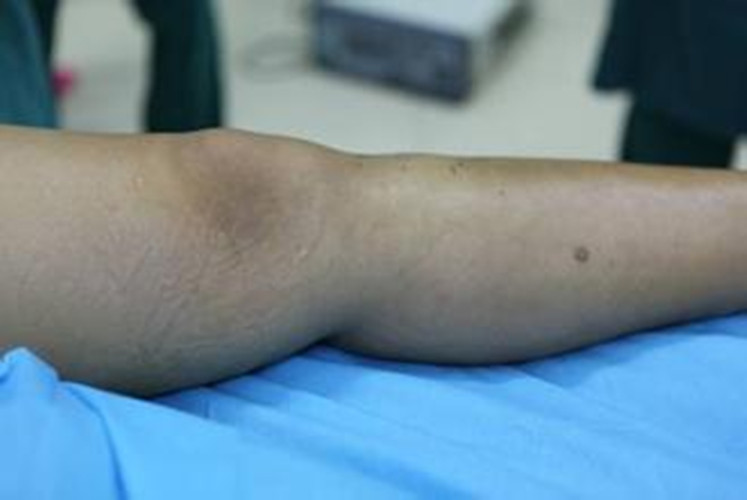 腿部良性骨腫瘤