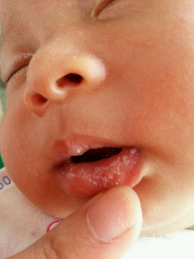寶寶鵝口瘡 (76) 