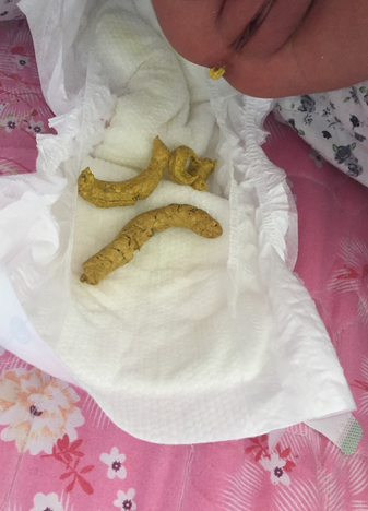新生兒消化不良大便圖 (53) 