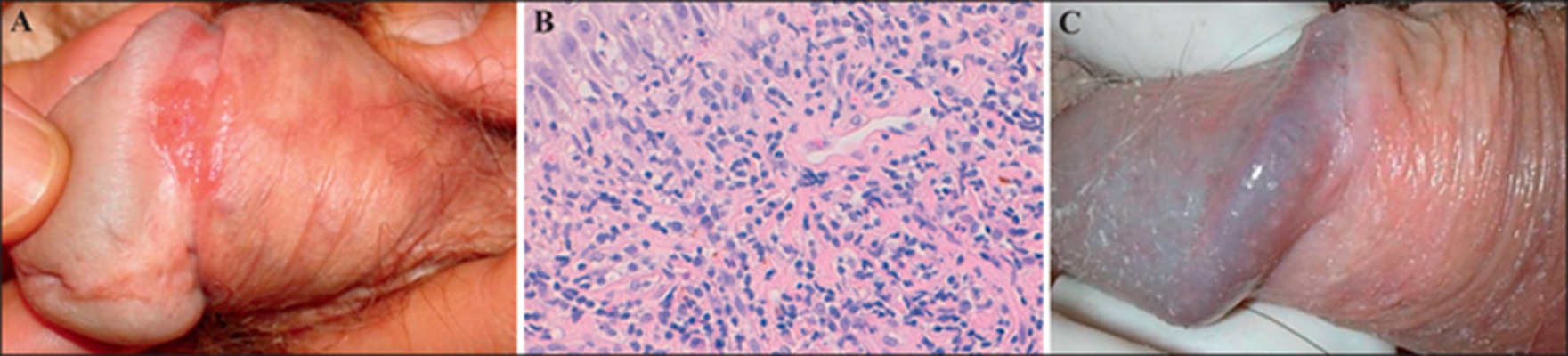 黴菌性龜頭炎 (8) 