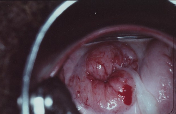 宮頸癌的早期症狀