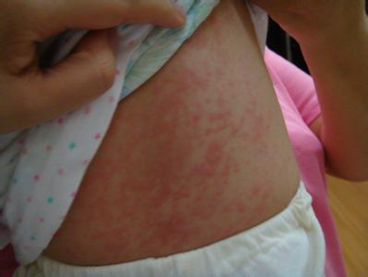 小兒猩紅熱症狀