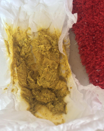 新生兒消化不良大便圖 (62) 