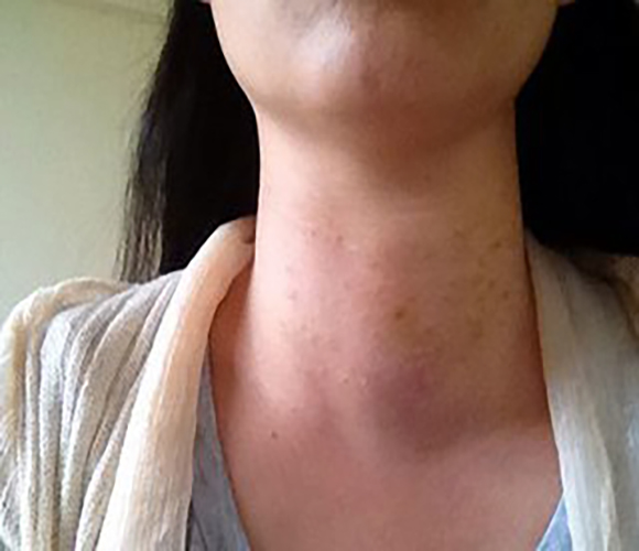 自身免疫學甲狀腺炎