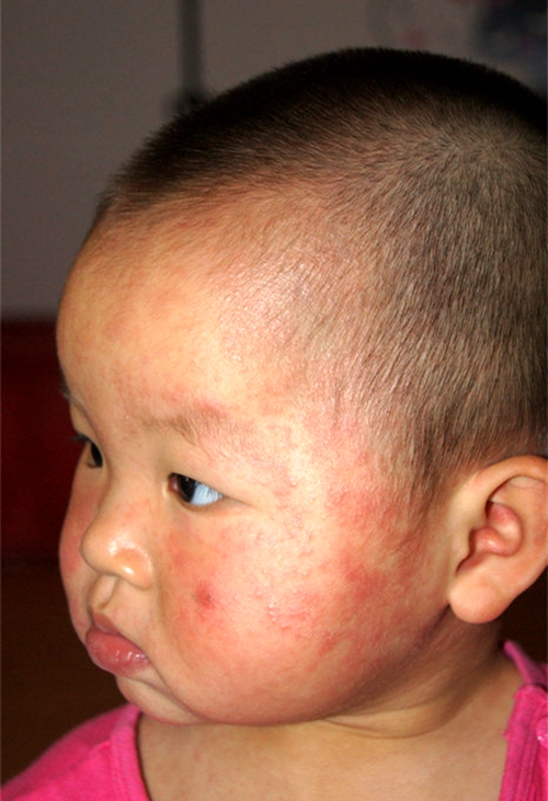 得了嬰幼兒急疹的寶寶 