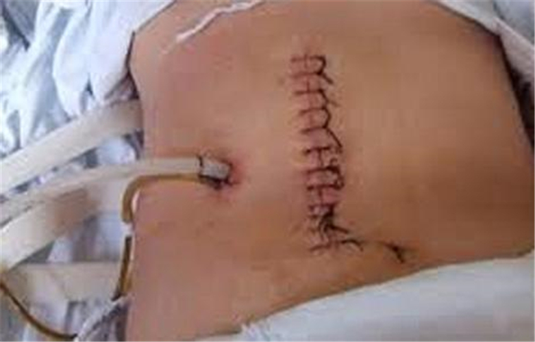 術後引發腸粘連