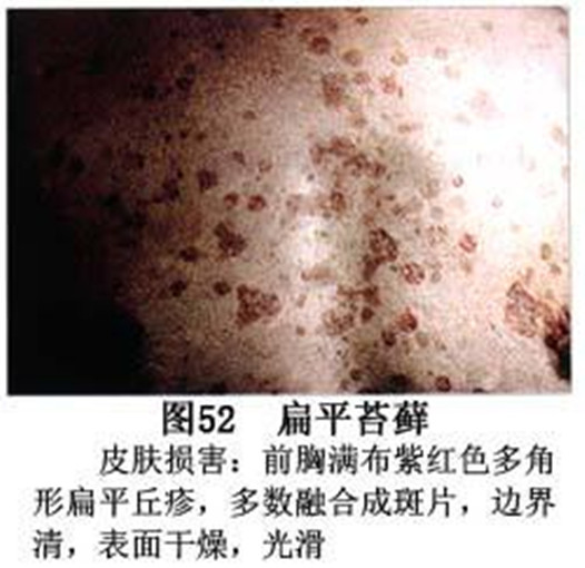 扁平苔蘚的治療方法 