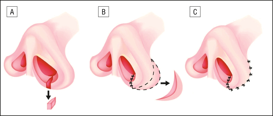 鼻中隔彎曲手術圖解 (34) 