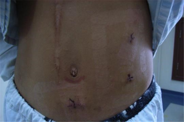 男性腸粘連治療後