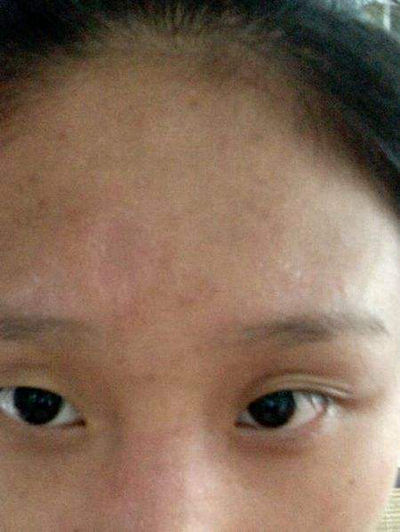 急性皮炎的症狀