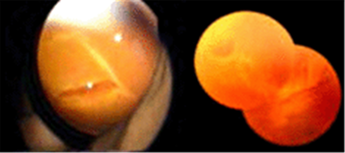 視網膜脫落組圖