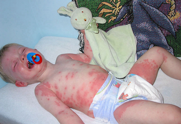 嬰兒蕁麻疹 (6) 