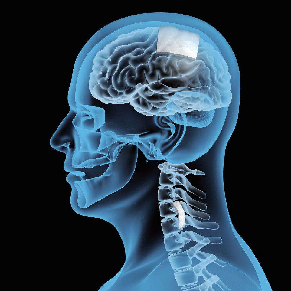 右側硬腦膜下出血 