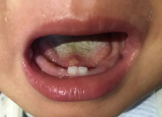 舌癌的初早期症狀