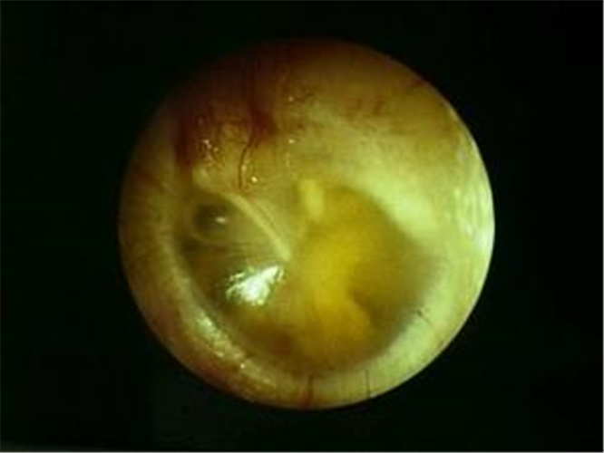 治療中的急性中耳炎
