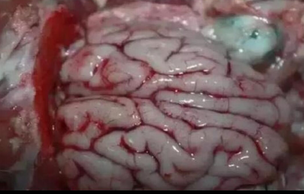 細菌性的腦膜炎