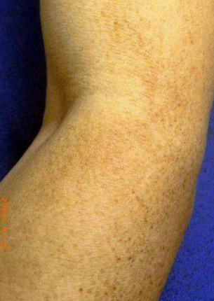 皮膚澱粉樣變 (62) 