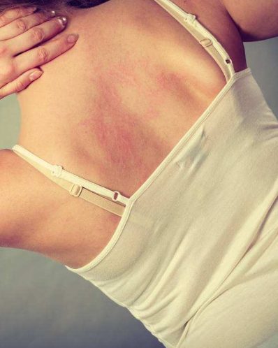 孕婦膽汁淤積症狀