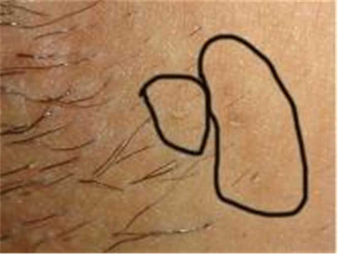 男早期假性溼疣圖 