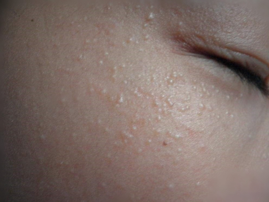 粟丘疹 (6) 
