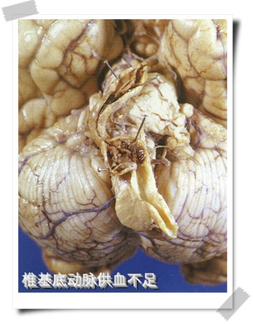 椎基底動脈供血不足導致腦供血不足