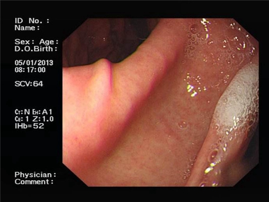 食道炎症狀 (30) 