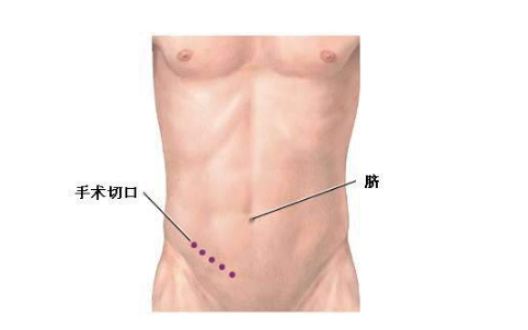 闌尾炎的症狀表現 (5) 