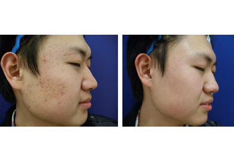磨皮手術效果圖 (7) 