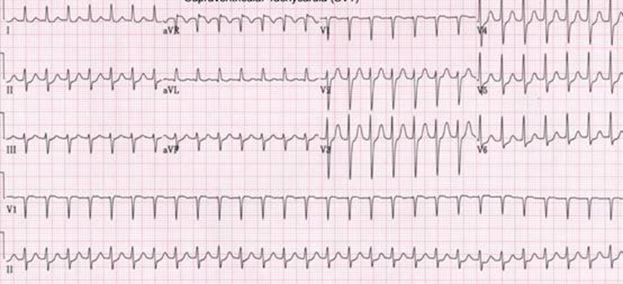預激綜合徵心電圖 (82) 