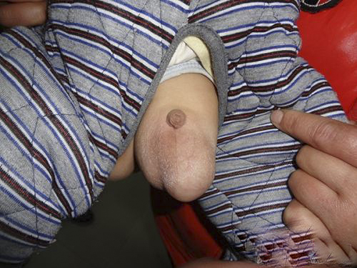 小兒鞘膜積液 (50) 