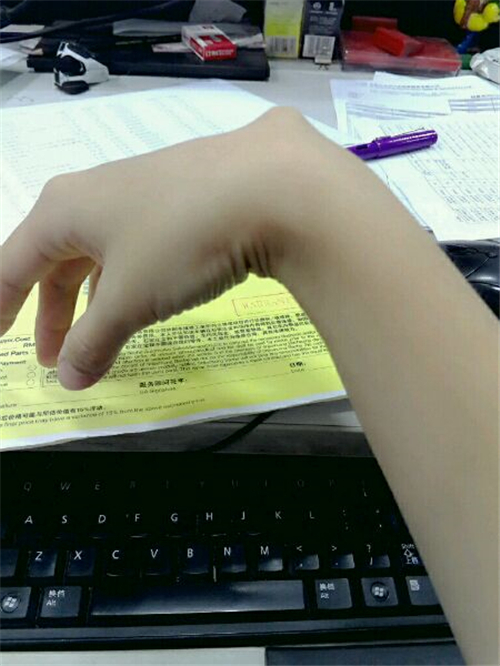 右手腕背面手腕腱鞘炎