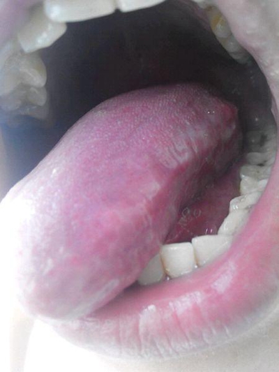 口腔念珠菌感染 (46) 