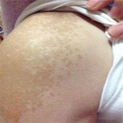 牛奶咖啡斑 (39) 