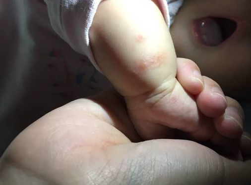 寶寶手上長水泡