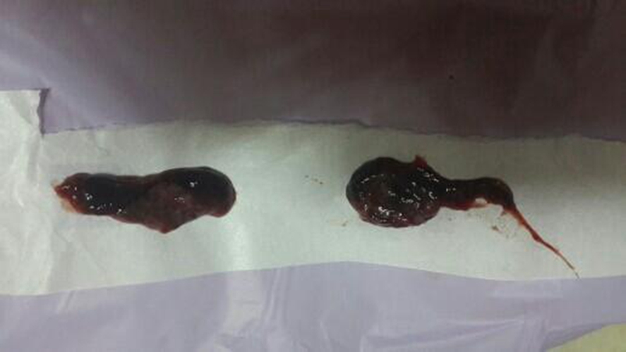 早孕藥流排出的孕囊的實體的