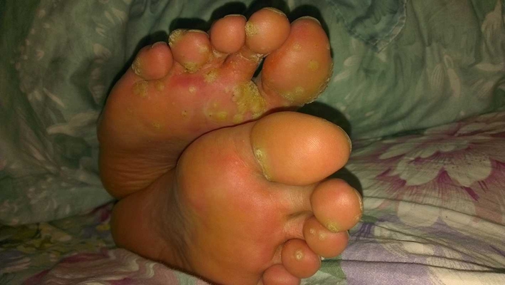 腳底蹠疣早期