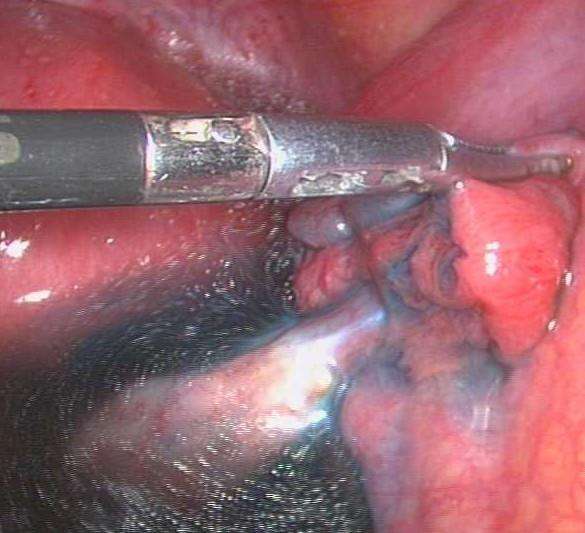 右側卵巢囊腫手術