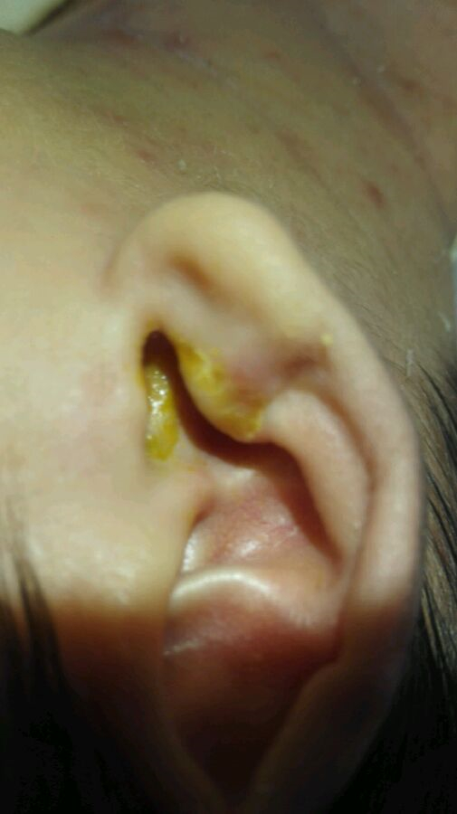 嬰兒急性中耳炎