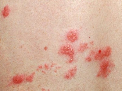 性病性淋巴肉芽腫套圖 (54) 