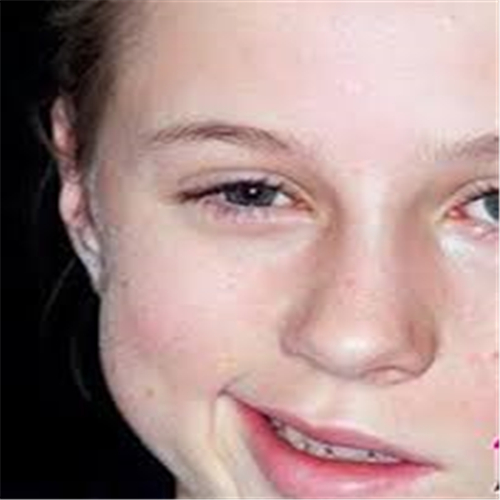 原發性面肌痙攣的