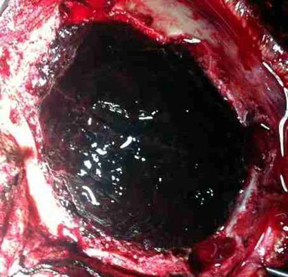 硬膜下血腫 (44) 