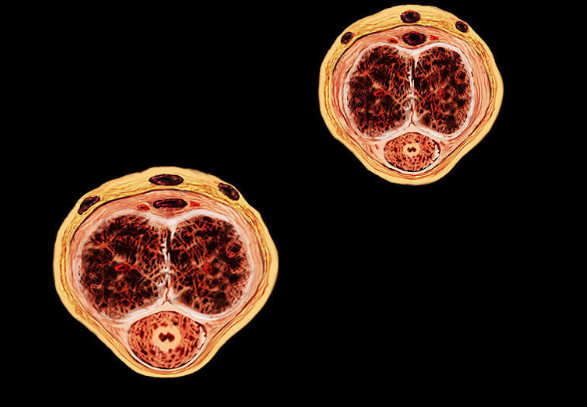精索曲張睪丸下墜時