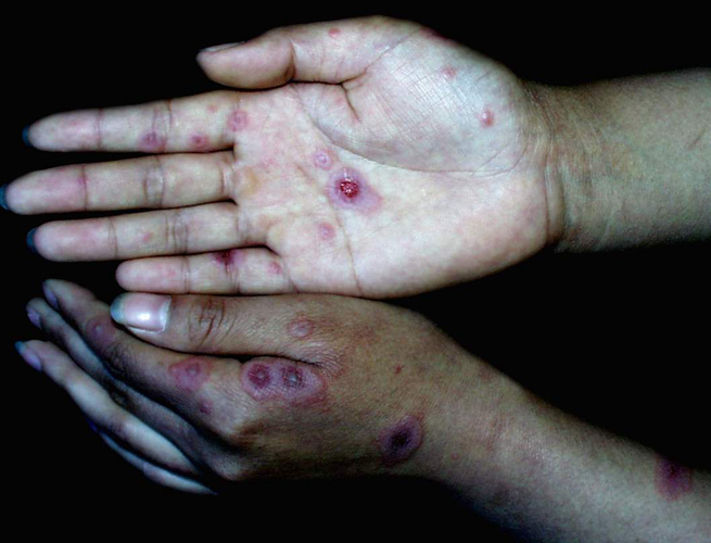 手部大皰性皮膚病