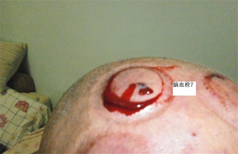 腦血栓針灸拔罐