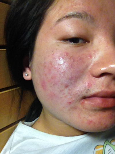 血熱的症狀痘痘