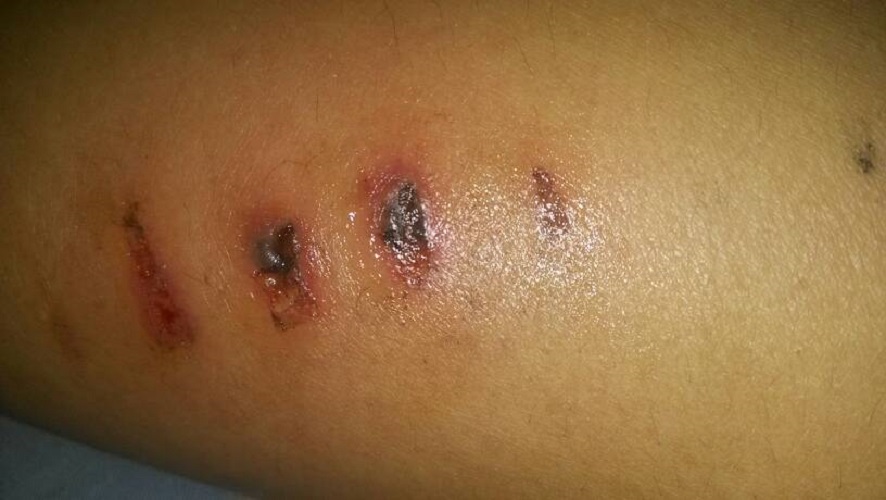 自行車鏈條扎傷的破傷風傷口