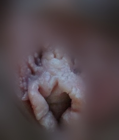 女性生殖器皰疹 (39) 