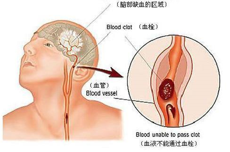 血栓導致腦供血不足